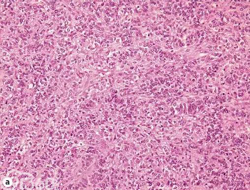 颗粒细胞瘤免疫组化图片