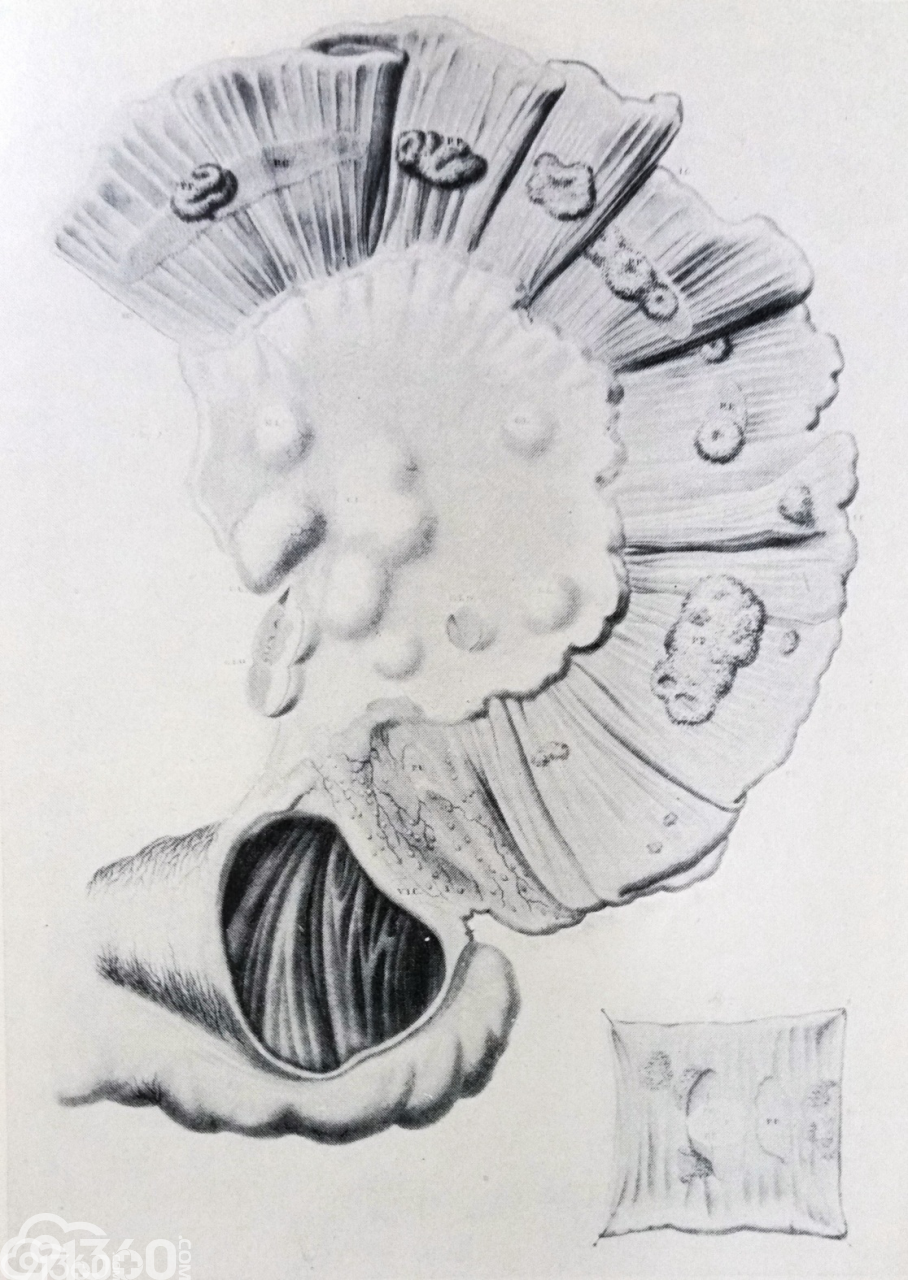 插图xxi (伤寒症中的)肠道溃疡   来自克吕韦耶《人体病理解剖学》