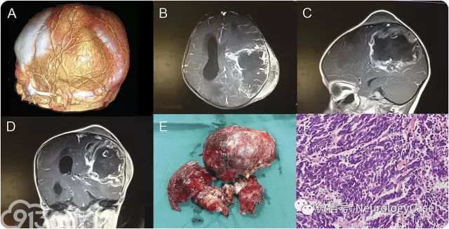 5岁女孩患原始神经外胚层肿瘤入院治疗病例分析