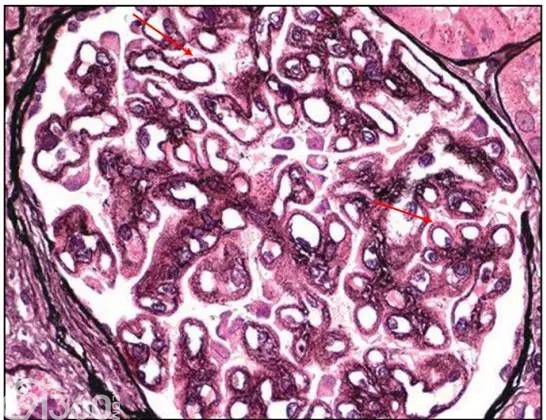 肾内病理图解 膜性肾病