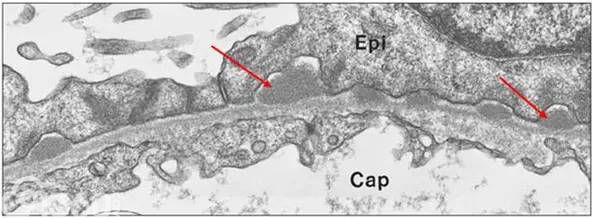 图14为epi:脏层上皮细胞(足细胞)