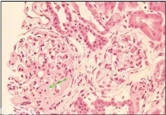 腎內病理圖解iga腎病