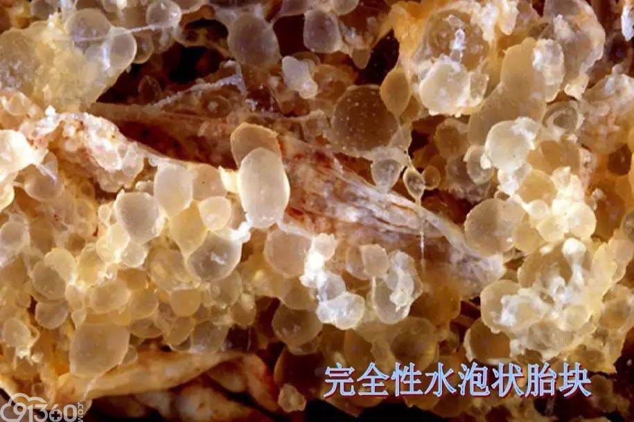 str片段分析技术在葡萄胎分子病理诊断中的应用