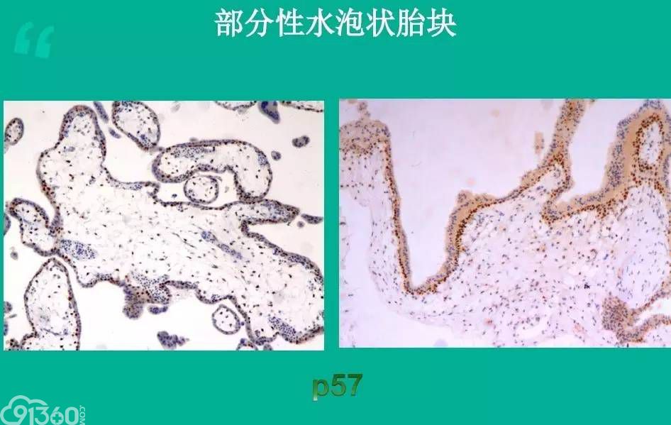 str片段分析技術在葡萄胎分子病理診斷中的應用