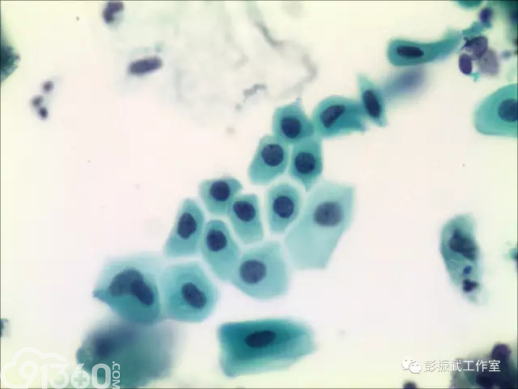 化生细胞 细胞中的骡子 91360智慧病理网