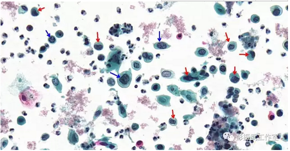 宫颈细胞学萎缩背景的认识(3)
