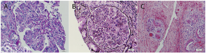 冷纤维蛋白原相关性肾病 - 病理杂谈 - 91360智慧病理网