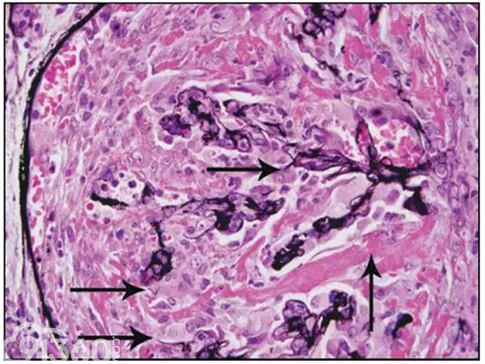 新月体性肾小球肾炎图片