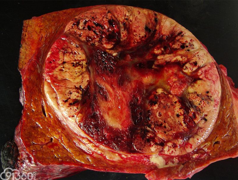 肝细胞癌切片图图片