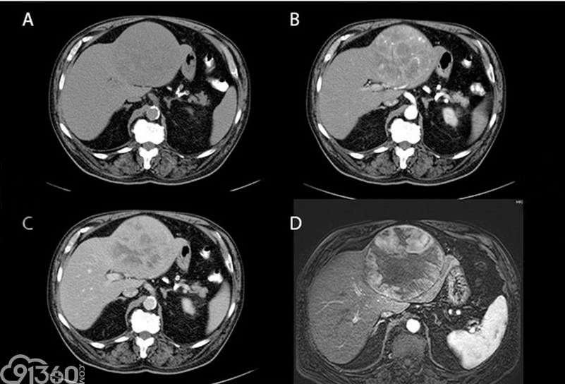 图解7种常见肝脏肿瘤—恶性篇 - 91360智慧病理网