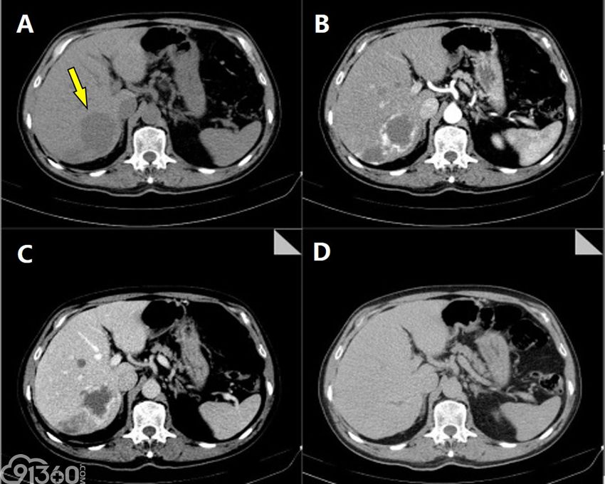 图解7种常见肝脏肿瘤—良性篇