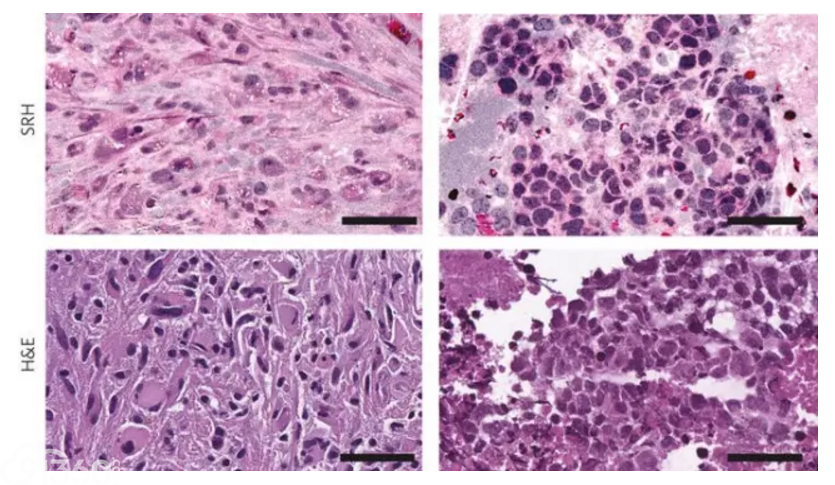 机器学习脑肿瘤虚拟染色助力快速诊断分类