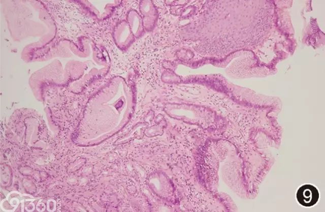 最新共识barrett食管的病理诊断