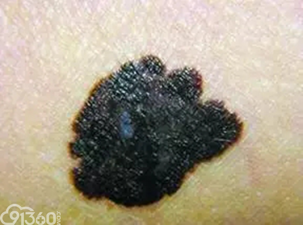 翻转课堂|黑色素瘤