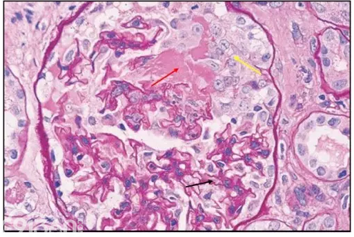 圖 9 he 染色:紅色箭頭:腎小球毛細血管內細胞增生,纖維素樣壞死
