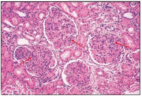 图 13 红色箭头:肾小球毛细血管腔内透明血栓样电子致密物;黄色箭头