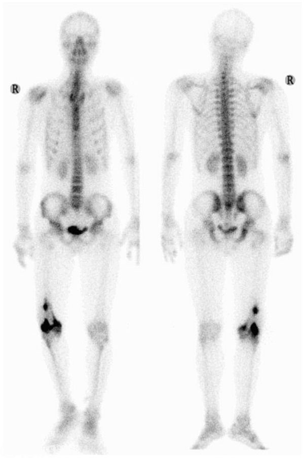Primary dedifferentiated liposarcoma of the femur presenting with malignant fibrous histiocytoma: A case report and review of the literature