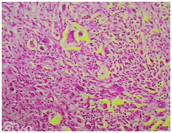 Primary dedifferentiated liposarcoma of the femur presenting with malignant fibrous histiocytoma: A case report and review of the literature
