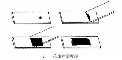 血涂片的制作图片