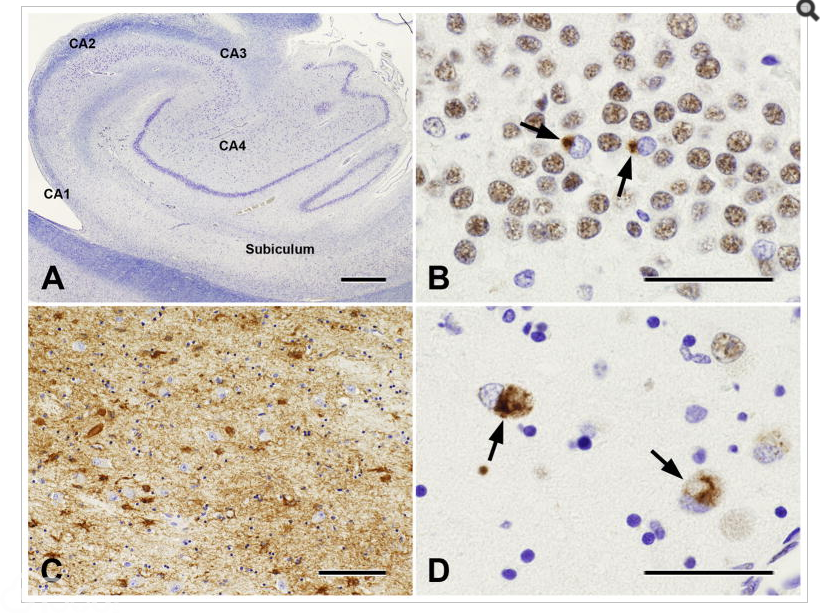 Surgical pathology of epilepsy-associated non-neoplastic cerebral lesions: a brief introduction with special reference to hippocampal sclerosis and focal cortical dysplasia