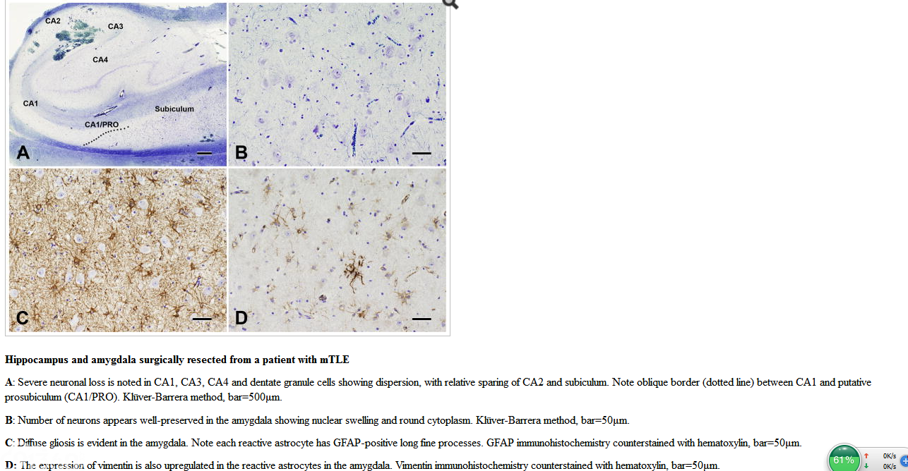 Surgical pathology of epilepsy-associated non-neoplastic cerebral lesions: a brief introduction with special reference to hippocampal sclerosis and focal cortical dysplasia