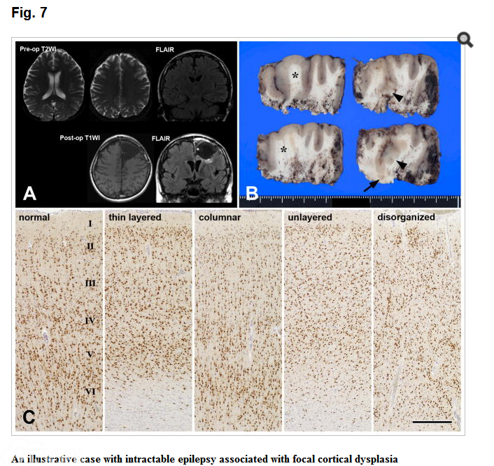 Surgical pathology of epilepsy-associated non-neoplastic cerebral lesions: a brief introduction with special reference to hippocampal sclerosis and focal cortical dysplasia