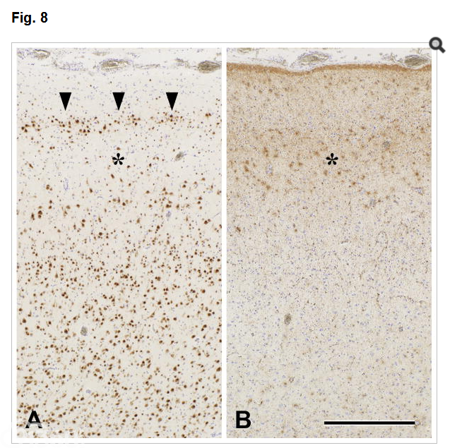 Surgical pathology of epilepsy-associated non-neoplastic cerebral lesions: a brief introduction with special reference to hippocampal sclerosis and focal cortical dysplasia