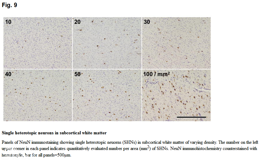 Surgical pathology of epilepsy-associated non-neoplastic cerebral lesions: a brief introduction with special reference to hippocampal sclerosis and focal cortical dysplasia